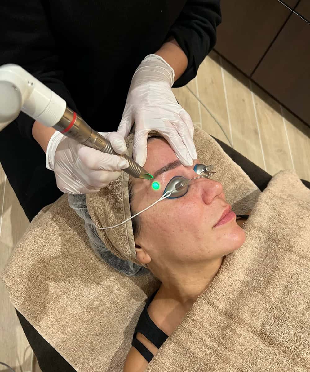 Dark Eye Circle treatment 2