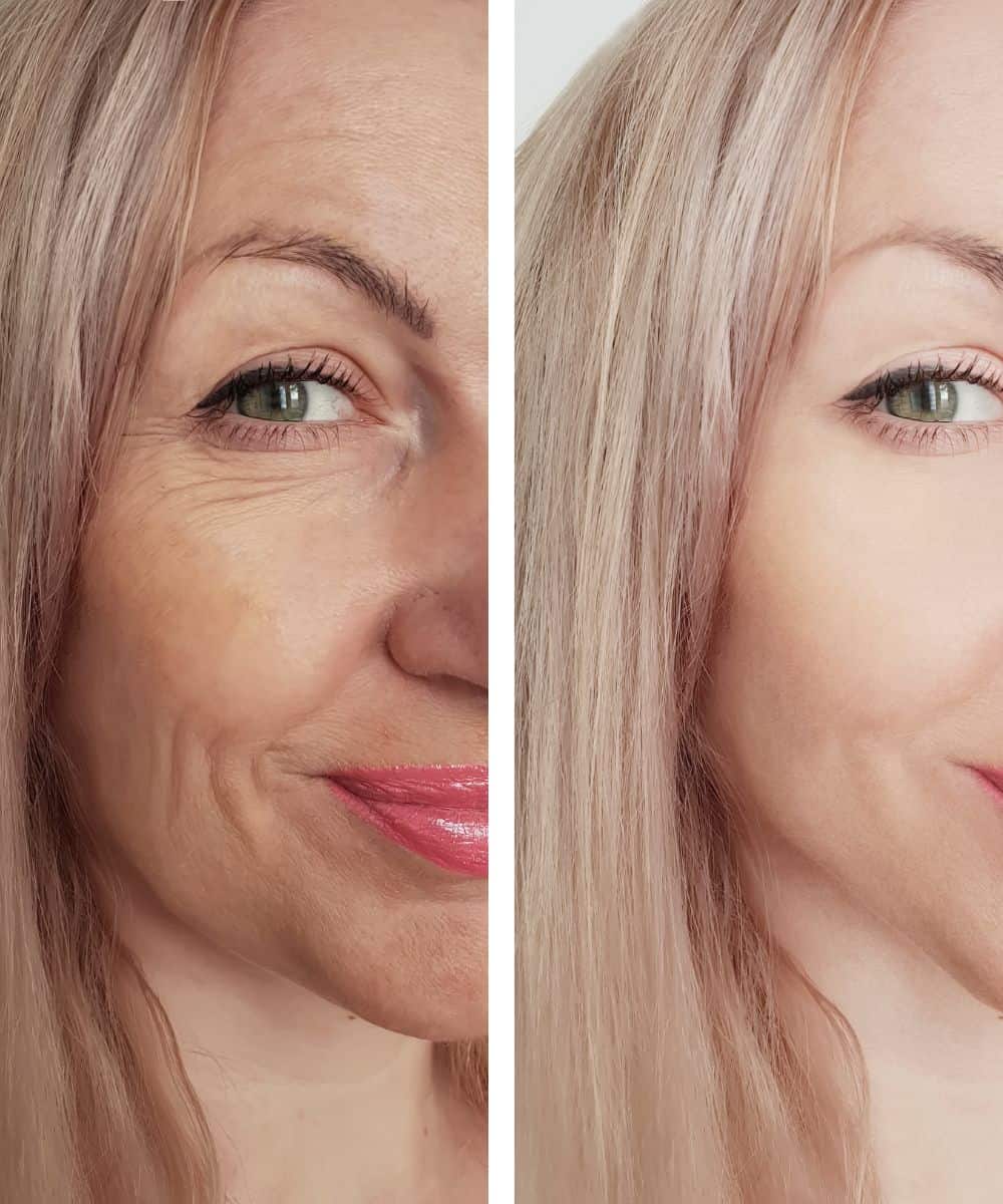 Fine lines & wrinkles (1)