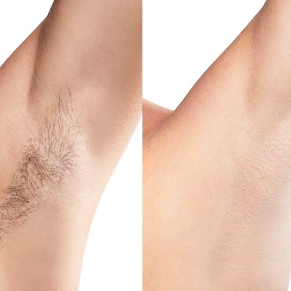 Hair Removal 2
