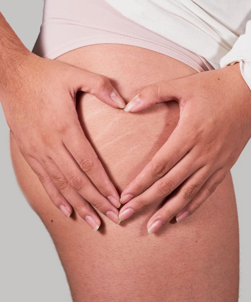 Cellulite Stretch marks image 2