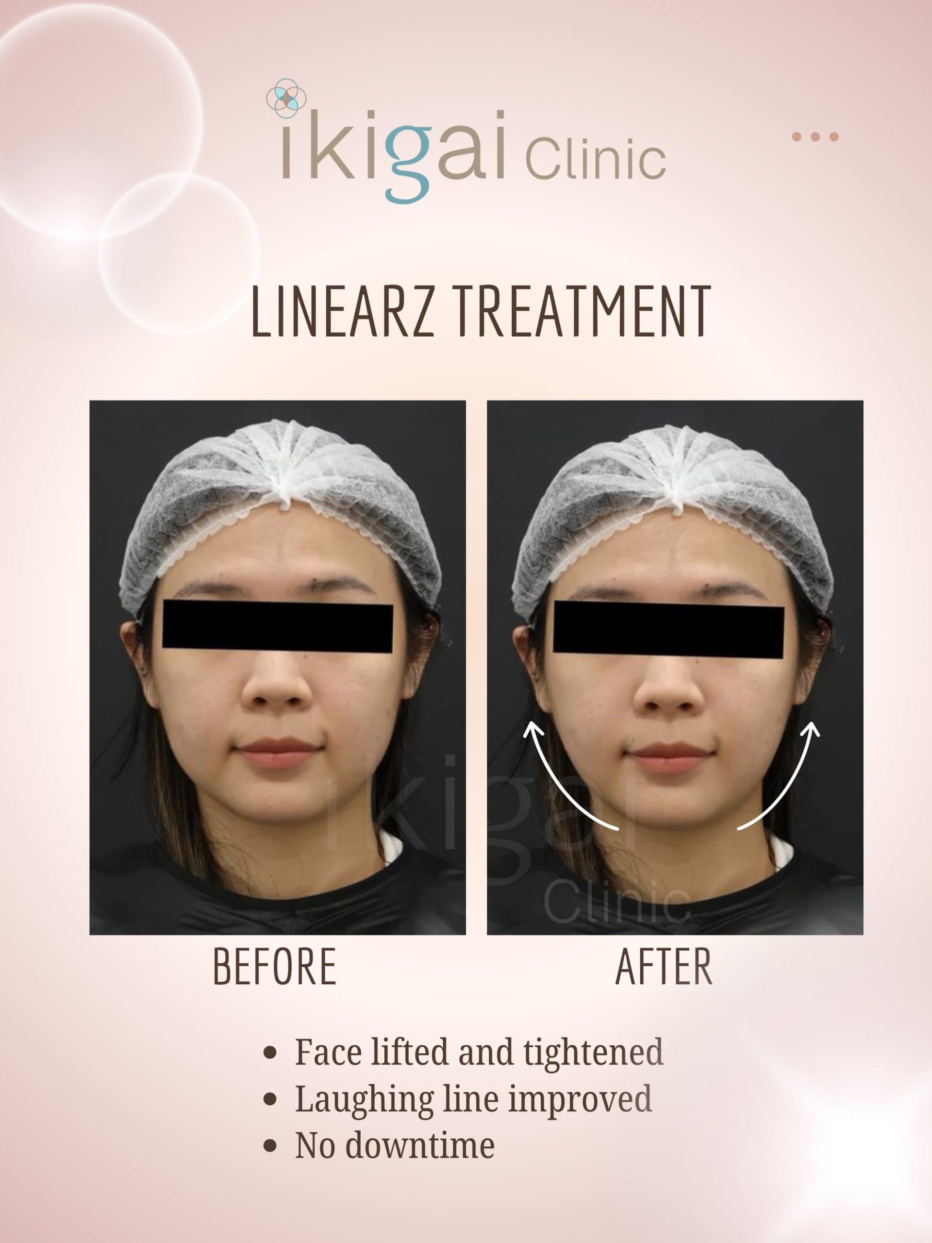 Linear-Z HIFU face lifting Petaling Jaya