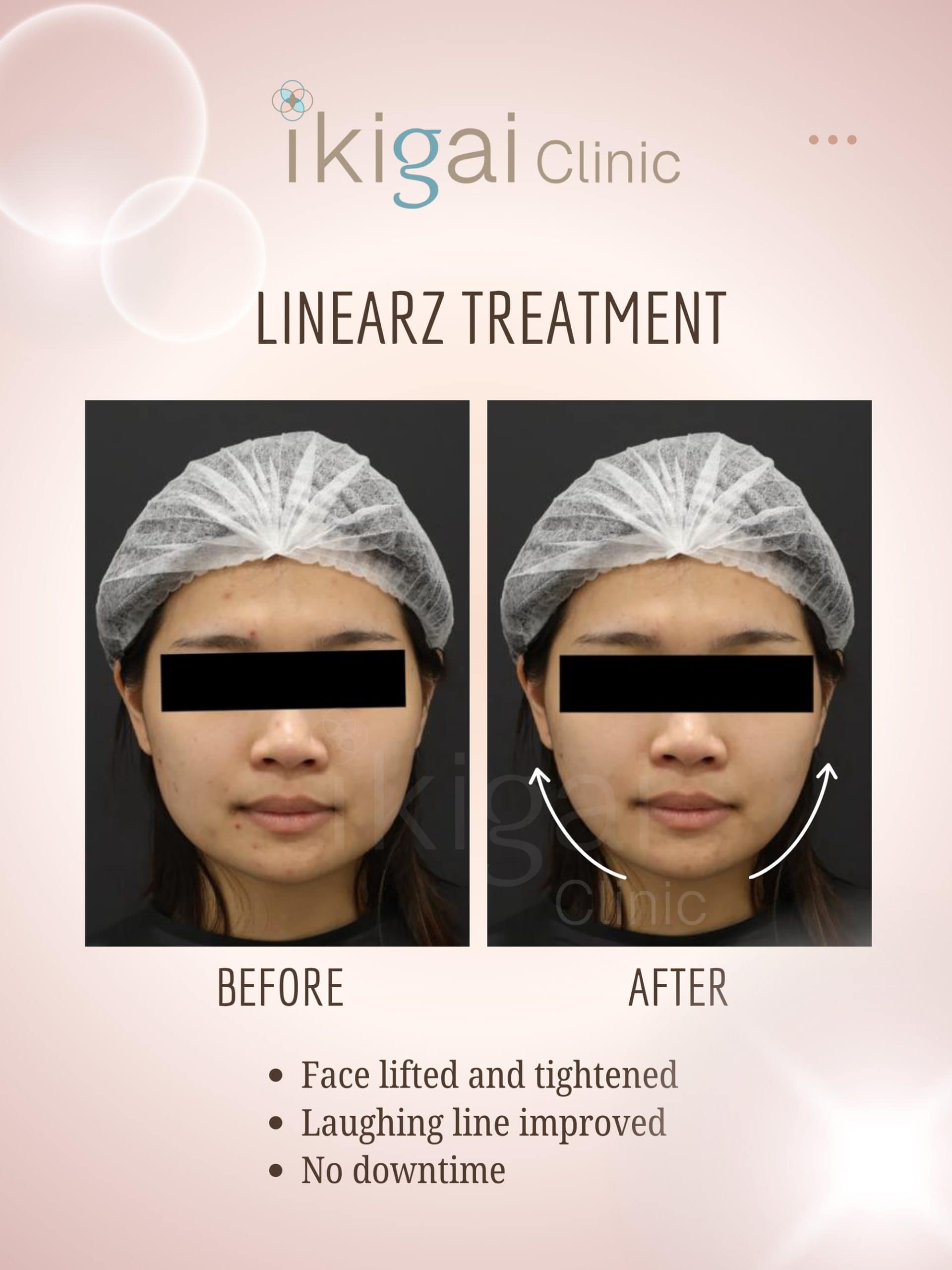 Linear-Z HIFU face lifting Petaling Jaya