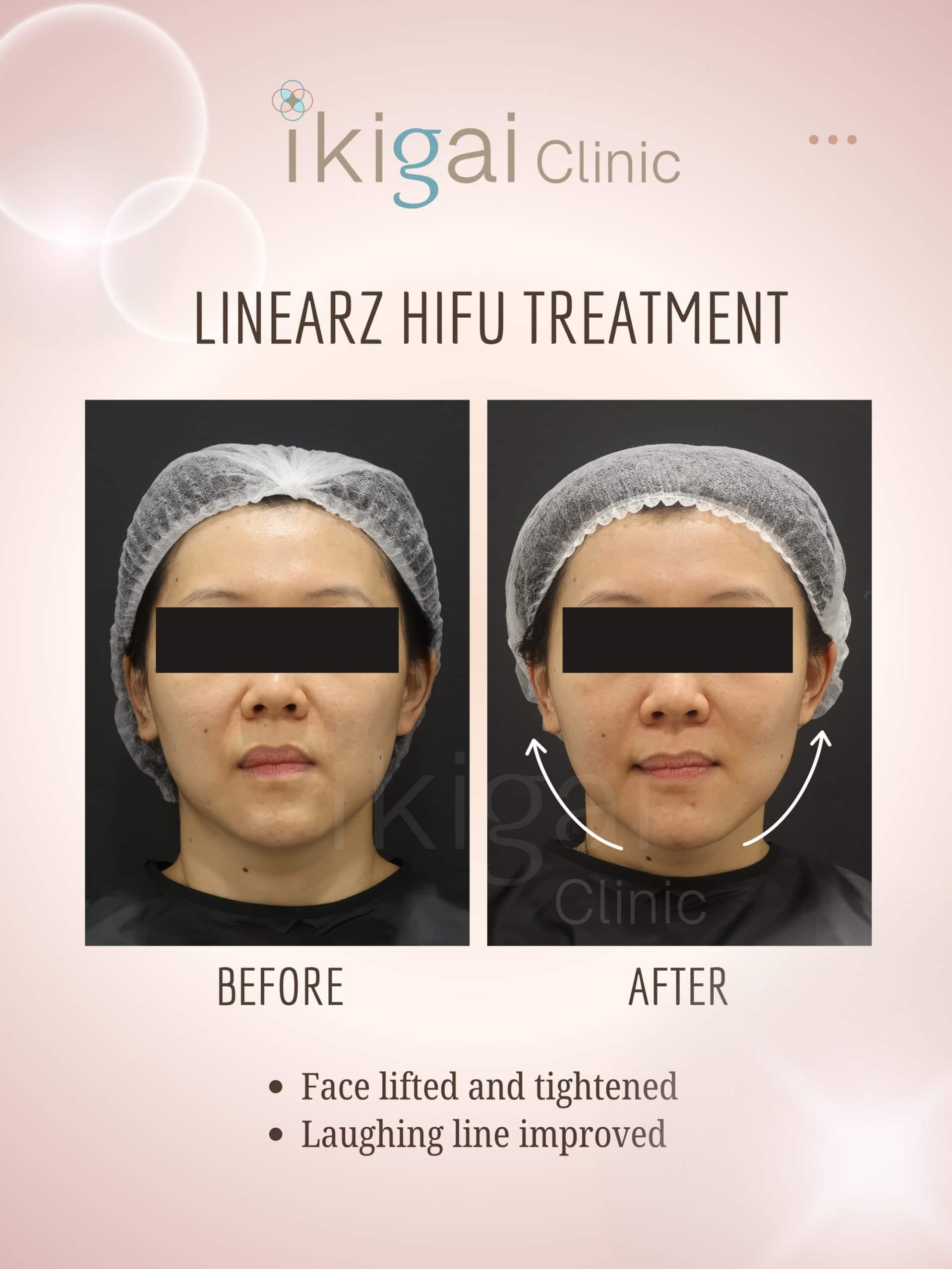 Linear-Z HIFU face lifting Petaling Jaya