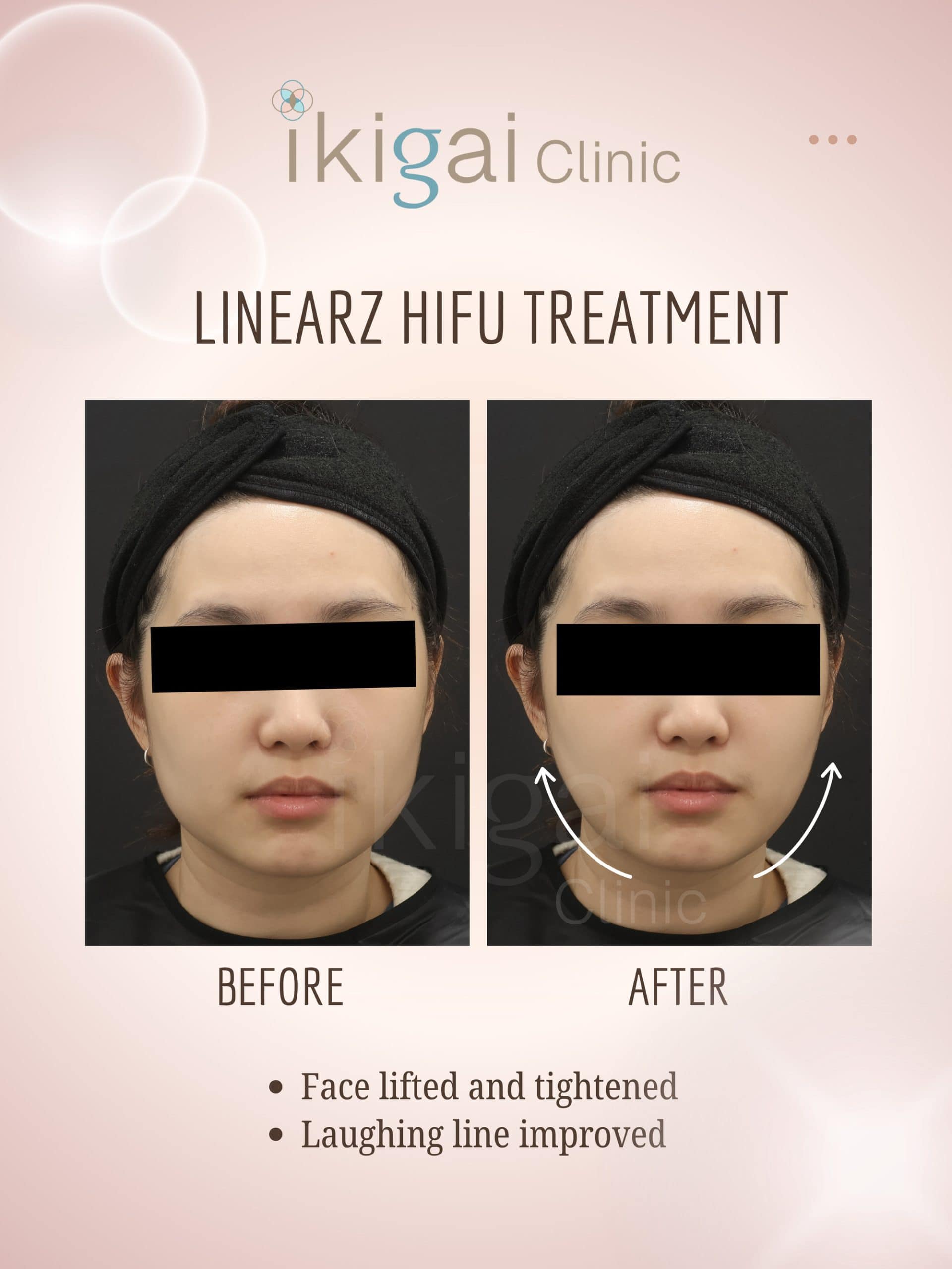 Linear-Z HIFU face lifting Petaling Jaya