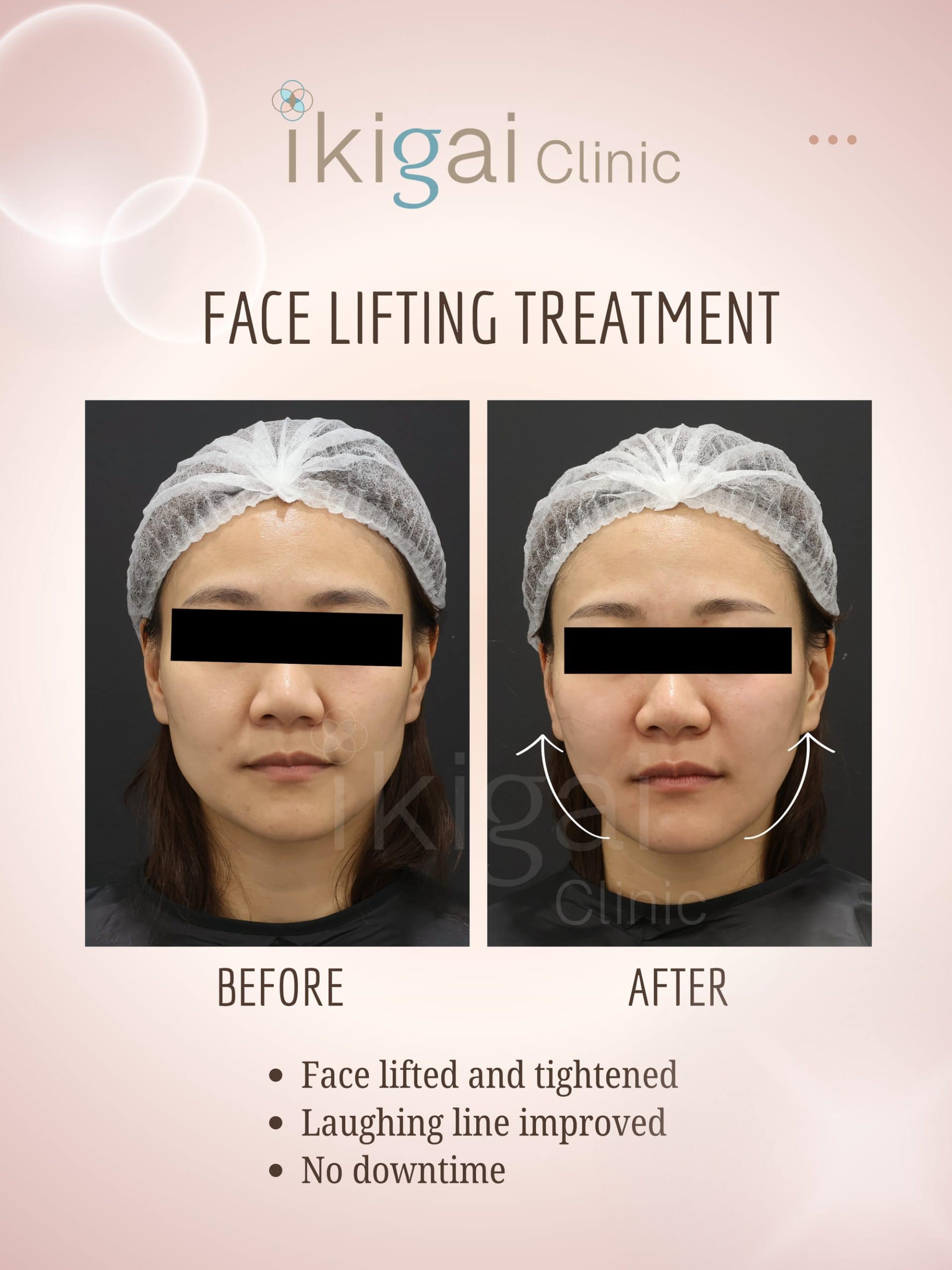 Linear-Z HIFU face lifting Petaling Jaya