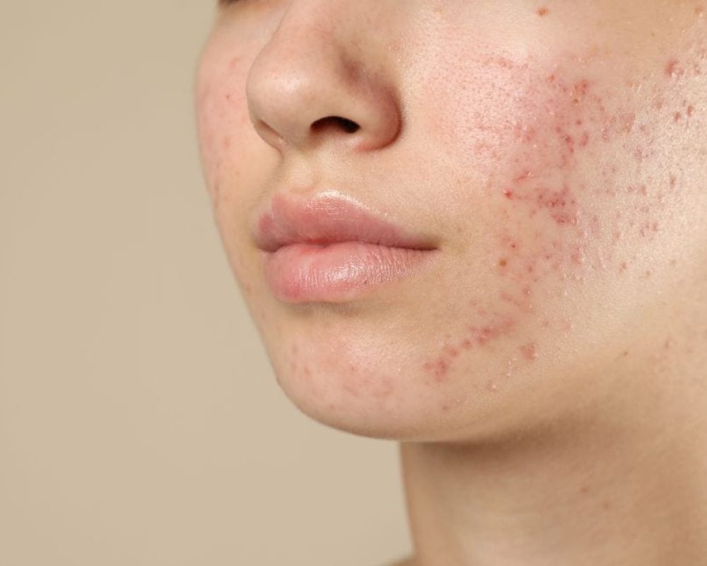 acne scars treatment Petaling Jaya