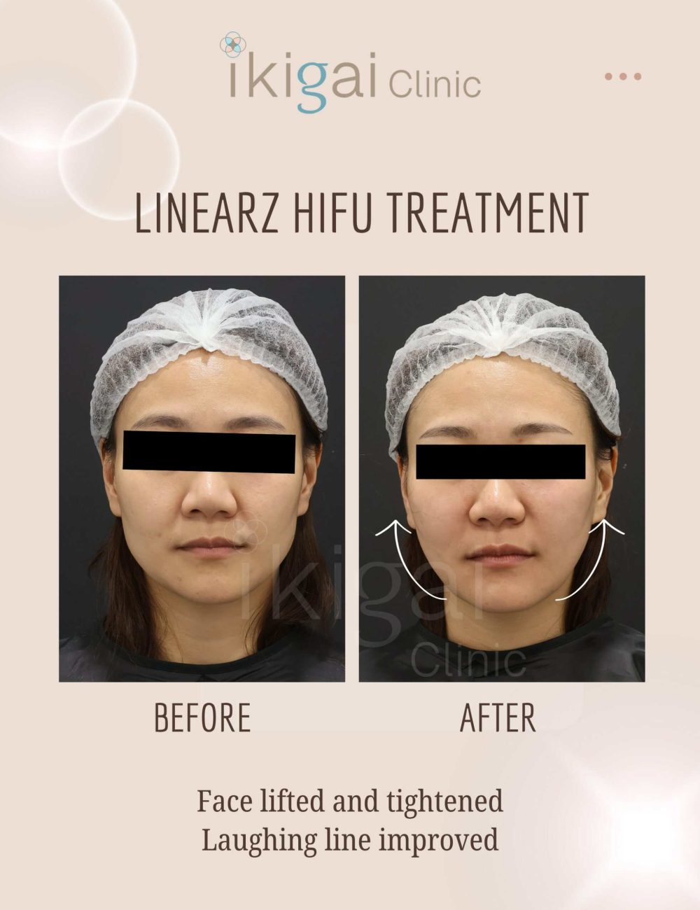 Before After Template