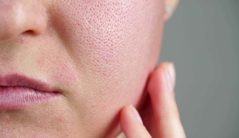 Open Pores Treatment Malaysia | Ikigai Clinic